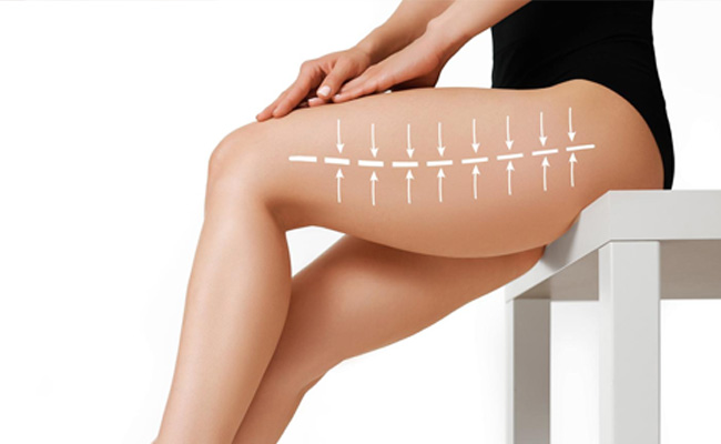 Thigh Lift Surgery