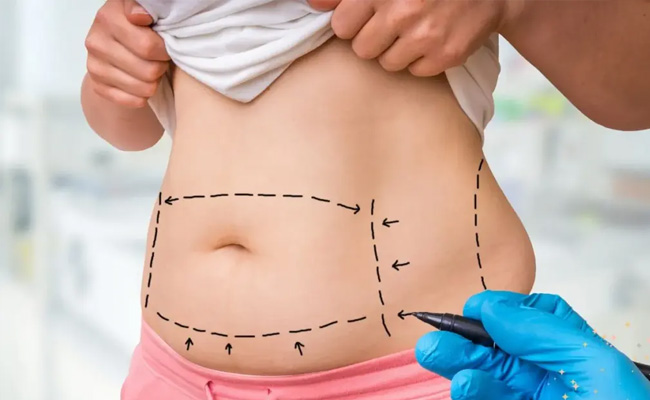Ultrasonic Liposuction Surgery