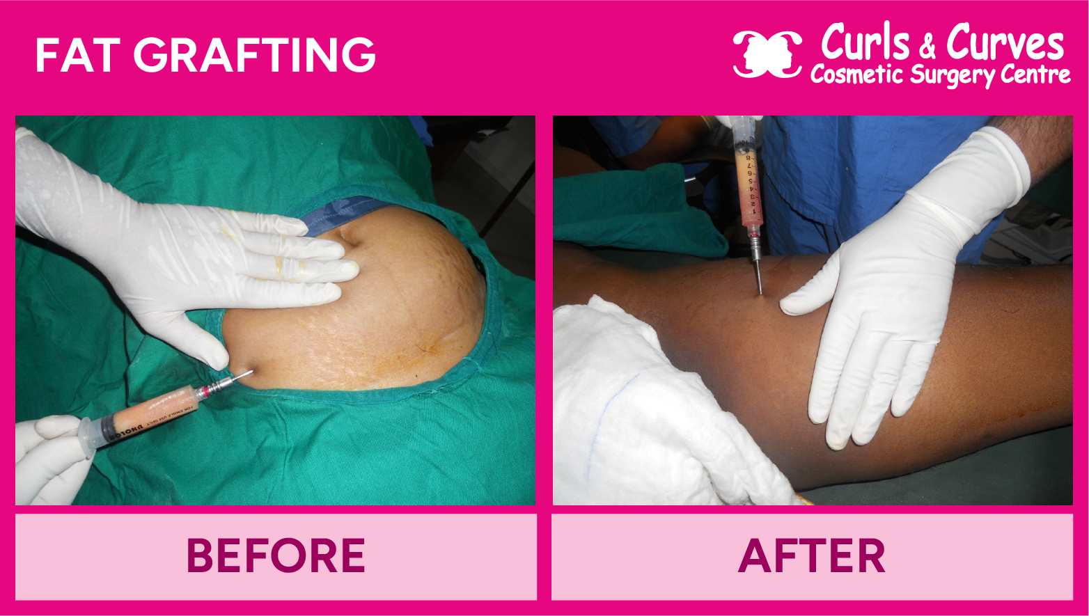 Fat Grafting Surgery in Bangalore – FAT GRAFTING-01